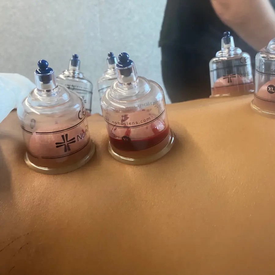 Hijama therapie precies Hijama therapie precies